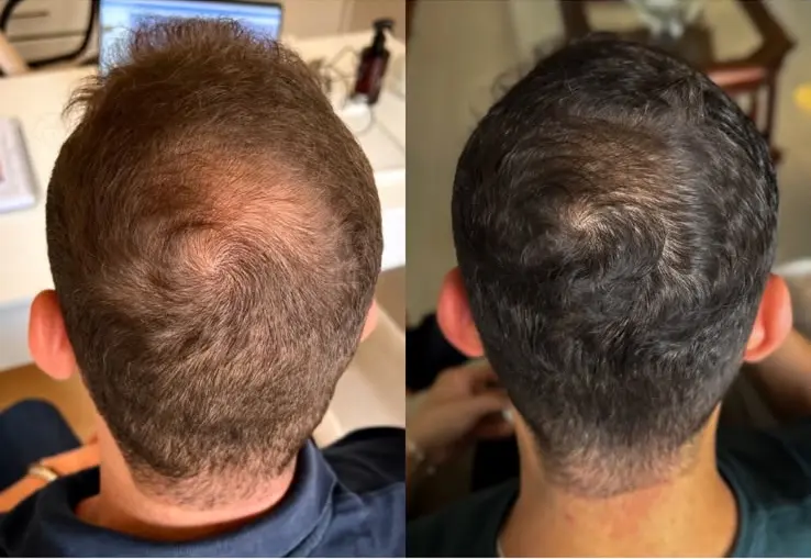 Alopecia Androgenética em Paciente Jovem (30 anos)
