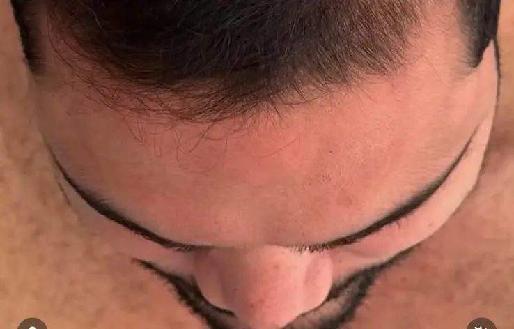 Acompanhamento de Linha Frontal e Entradas