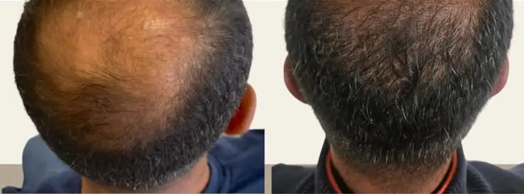 Protocolo Genesis + Acompanhamento Clínico